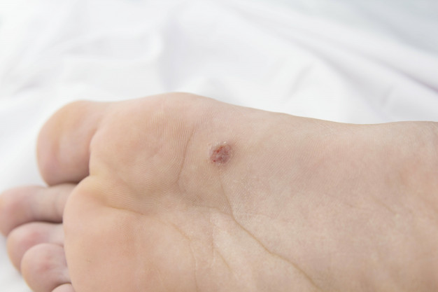 flat warts always healthy hindi