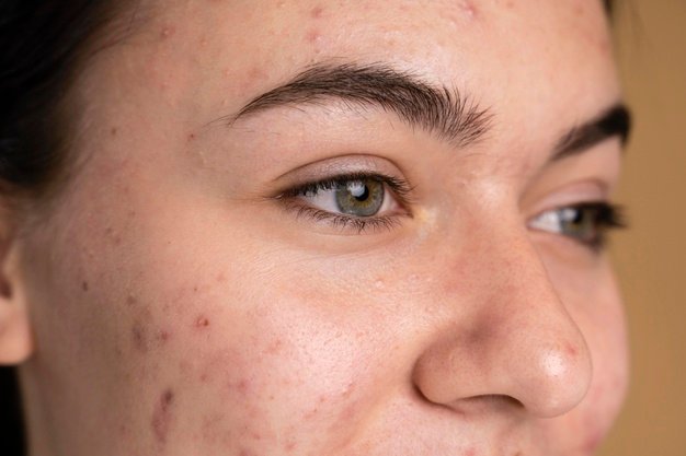 Acne pimples Always Healthy Fits
