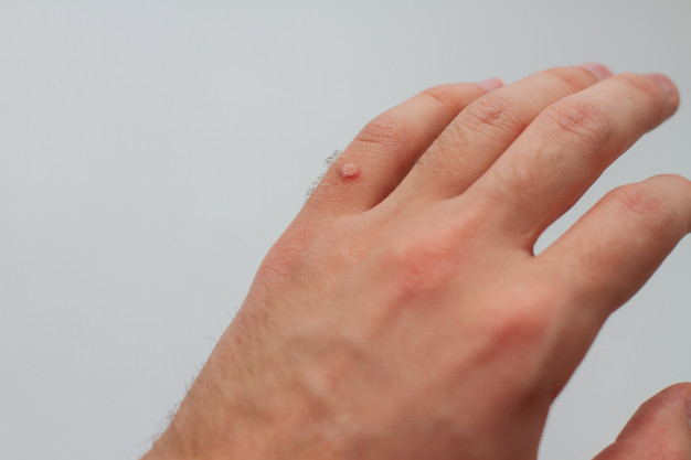 common warts Always Healthy hindi