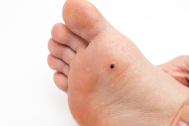 planter warts Always healthy hindi
