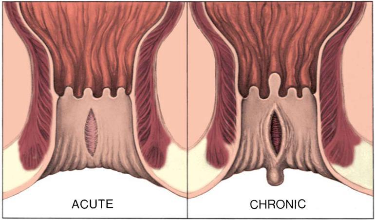  Anal fissure pain in hindi