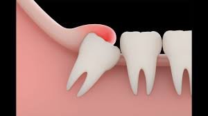  Wisdom tooth pain Home remedies