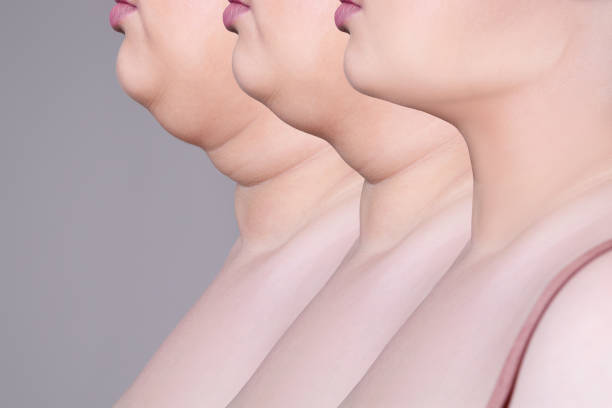 What causes a double chin