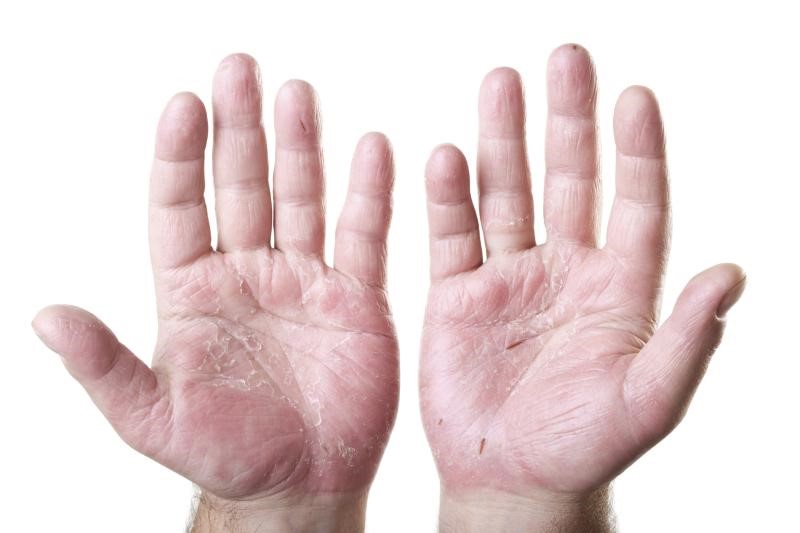 Natural Remedy for Dry Hands in hindi