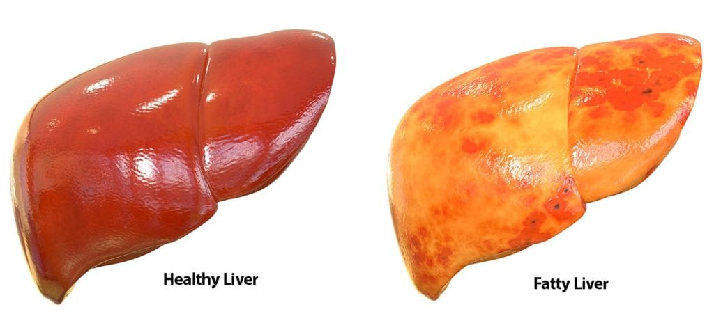 Healthy liver and fatty liver