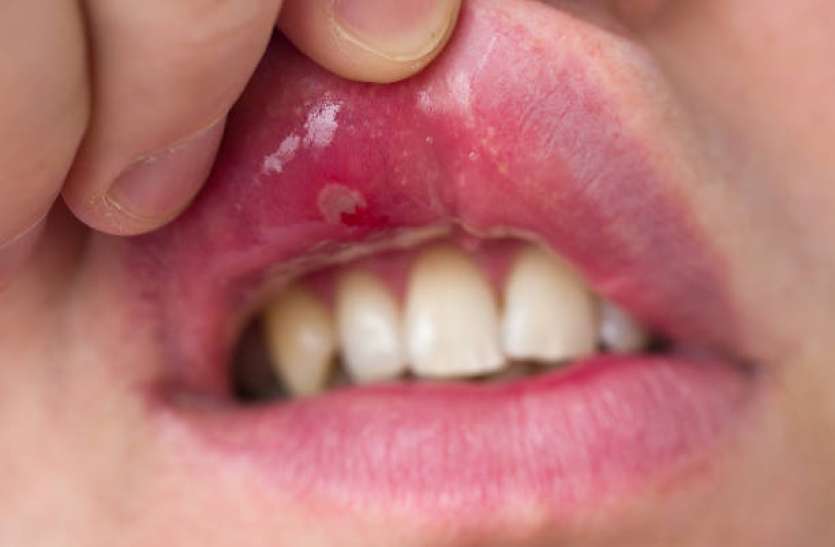 Home Remedies For Mouth Ulcers in hindi