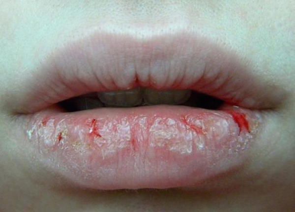 Cracked Lips Remedies in hindi