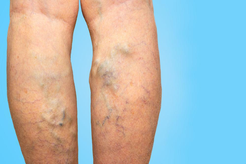 Varicose veins in hindi