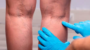 Varicose veins treatment in hindi