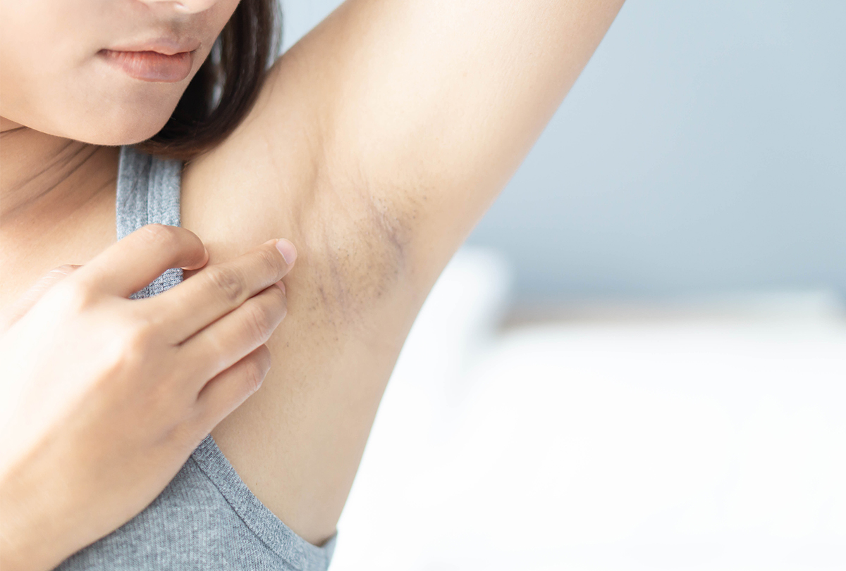 Home remedies to dark underarms