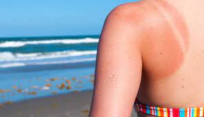 Home Remedies for Sunburn