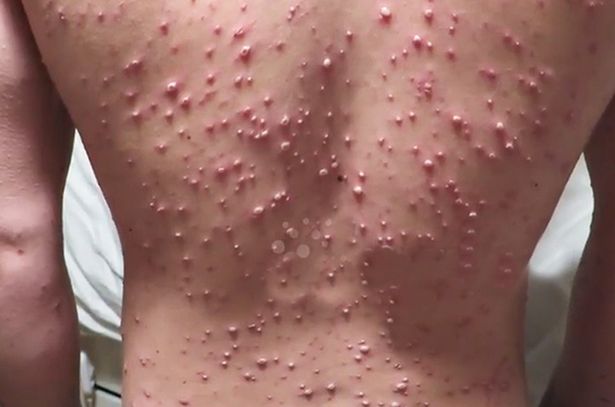 get rid of sweat rash