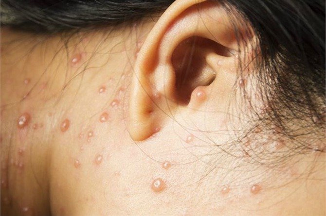 chickenpox in hindi