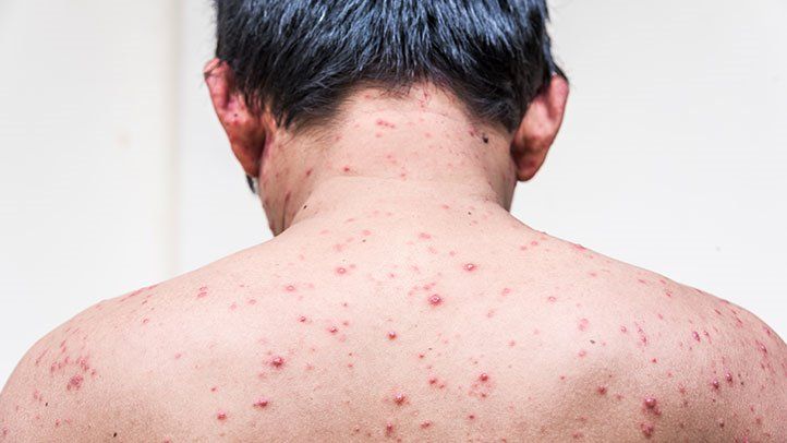 chickenpox in hindi