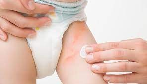 diaper rash home remedies