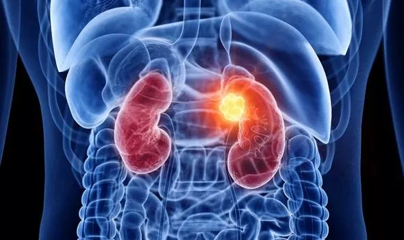 kidney stones in hindi