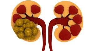 kidney stones in hindi