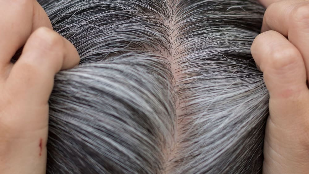 Gray Hair Solution in hindi