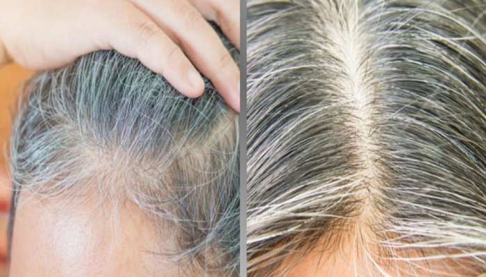 Gray Hair Solution in hindi