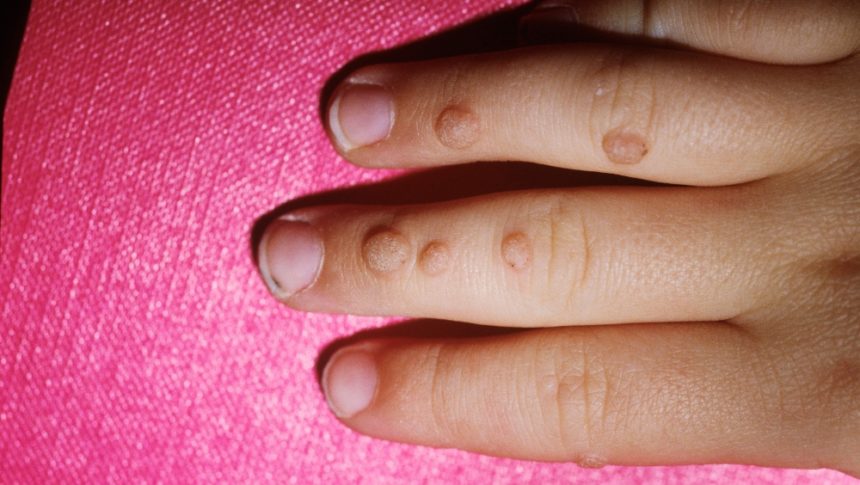 warts in hindi