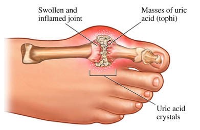 Mastering Uric Acid: Simple Solutions for a Healthy You!