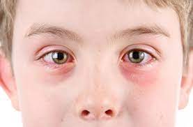 Home Remedies for Pink Eye: Soothe Your Eyes the Natural Way