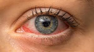 Conjunctivitis Home Remedies: Clearing Up Pink Eye with Ease